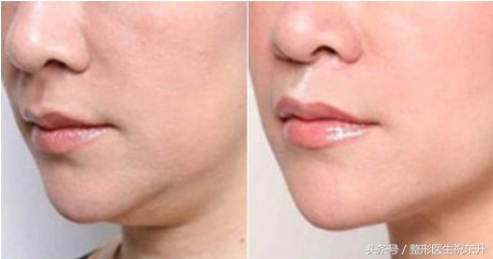 脸胖了还能瘦下来吗,脸胖了很多要怎么瘦