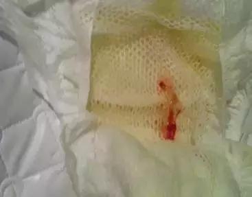 刚出生女宝宝尿布上有血啥原因,女婴尿布上有血迹家长没有在意