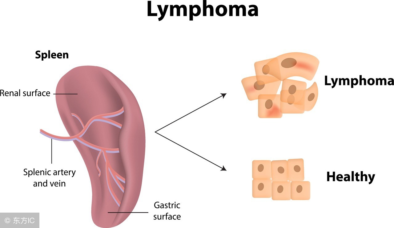什么因素会得淋巴癌,淋巴癌是什么原因引起淋巴癌的