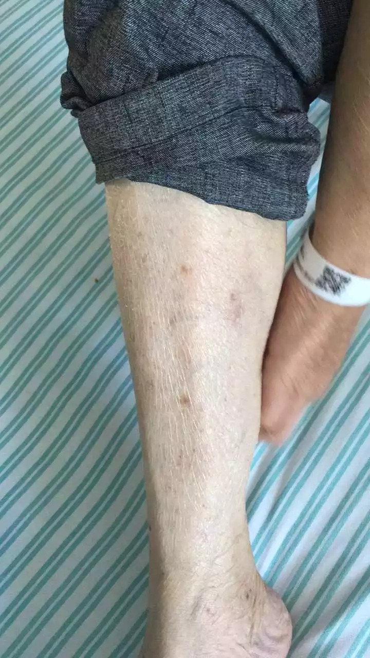 皮炎平软膏导致黑色素沉着,大伯吃掉上百支皮炎平软膏