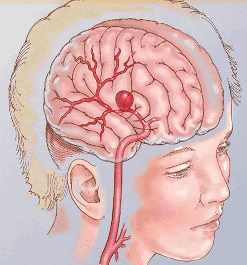 蛛网膜下腔出血最常见的原因为,蛛网膜下腔出血会留下什么后遗症