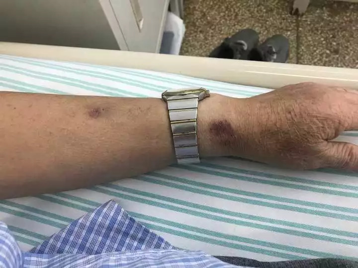 天呐!大爷吃掉上百支“皮炎平”软膏,医生一问都懵了