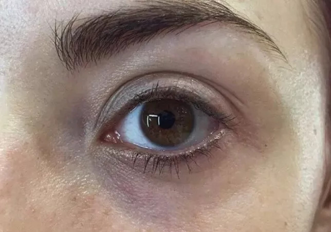 黑眼圈一直去不掉有其它原因吗,十几年黑眼圈去不掉是怎么回事