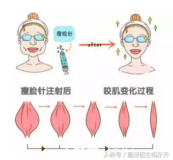 除皱肉毒针,肉毒素除皱进针多深