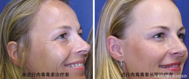 除皱肉毒针,肉毒素除皱进针多深