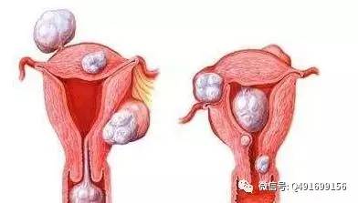 女性切除子宫对身体有什么危害,女性切除子宫对身体有什么影响吗