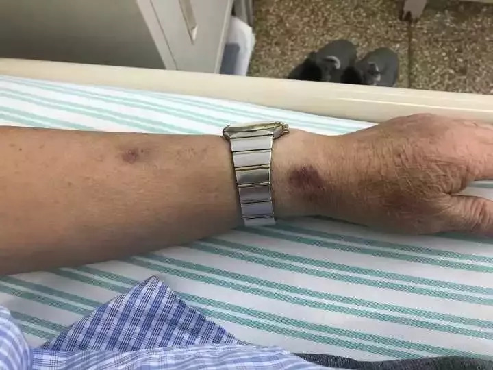 天呐！大爷3年吃掉100多支“皮炎平”软膏！医生一……