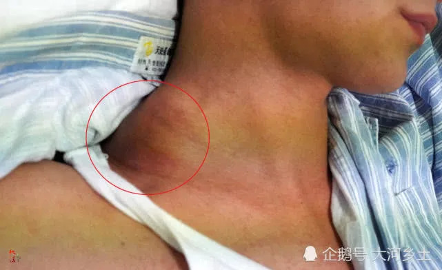 27岁新婚小伙得癌症原创视频,27岁小伙新婚不久被查出癌症