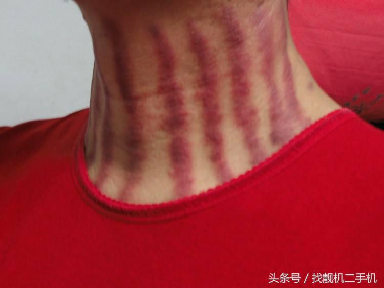 刮完痧第二天排便轻松,后背刮完痧特别轻松