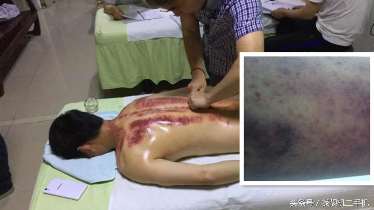 刮完痧第二天排便轻松,后背刮完痧特别轻松