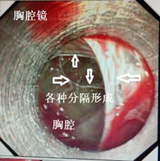 胸水抽了为什么还呼吸困难,胸水抽不出来了怎么回事