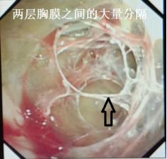 胸水抽了为什么还呼吸困难,胸水抽不出来了怎么回事