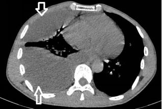 胸水抽了为什么还呼吸困难,胸水抽不出来了怎么回事