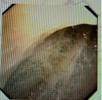 胸水抽了为什么还呼吸困难,胸水抽不出来了怎么回事