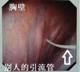 胸水抽了为什么还呼吸困难,胸水抽不出来了怎么回事