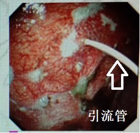 胸水抽了为什么还呼吸困难,胸水抽不出来了怎么回事