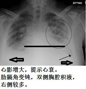 胸水抽了为什么还呼吸困难,胸水抽不出来了怎么回事