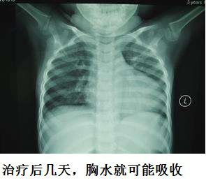 胸水抽了为什么还呼吸困难,胸水抽不出来了怎么回事