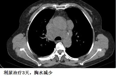 胸水抽了为什么还呼吸困难,胸水抽不出来了怎么回事