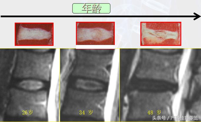 椎间盘突出如何保养防复发,椎间盘突出手术复发后中医治疗