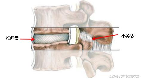 椎间盘突出如何保养防复发,椎间盘突出手术复发后中医治疗
