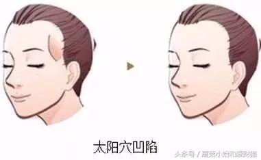 脸大面部凹陷的人好显老,脸上好多凹陷怎么回事