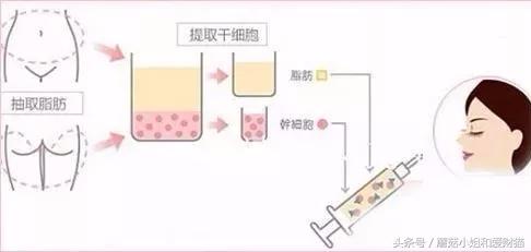 脸大面部凹陷的人好显老,脸上好多凹陷怎么回事