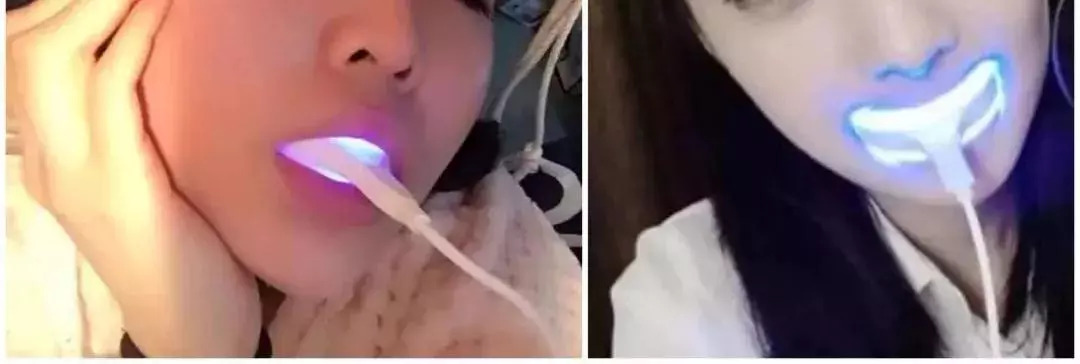 市面上冷光美牙仪真的有用吗,冷光美牙仪对牙齿伤害有多大