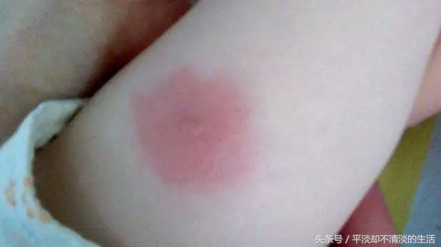 蚊虫叮咬中药治疗方法,蚊虫叮咬良方