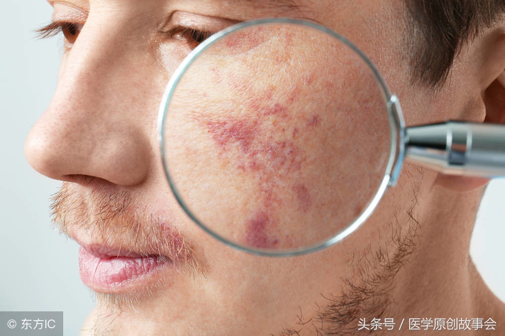 胸口出现蜘蛛痣去医院查什么,肝硬化长痣是什么意思