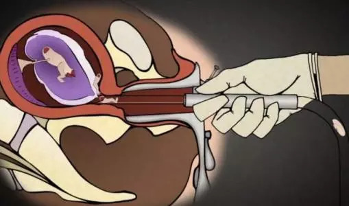 流产中的胎儿会有痛苦感受吗？流产后的他们又都去了哪里？