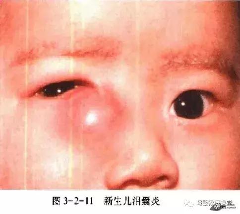 孩子发烧后眼屎突然增多怎么回事,三岁宝宝眼屎突然增多是怎么回事