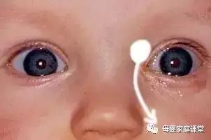 孩子发烧后眼屎突然增多怎么回事,三岁宝宝眼屎突然增多是怎么回事