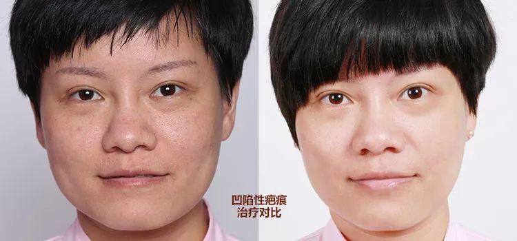 微针值得做吗,口碑最好的微针