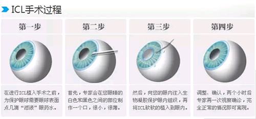 近视怎么改善眼力,近视了还能提高裸眼视力吗