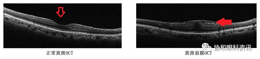 莫将黄斑前膜当“老花”