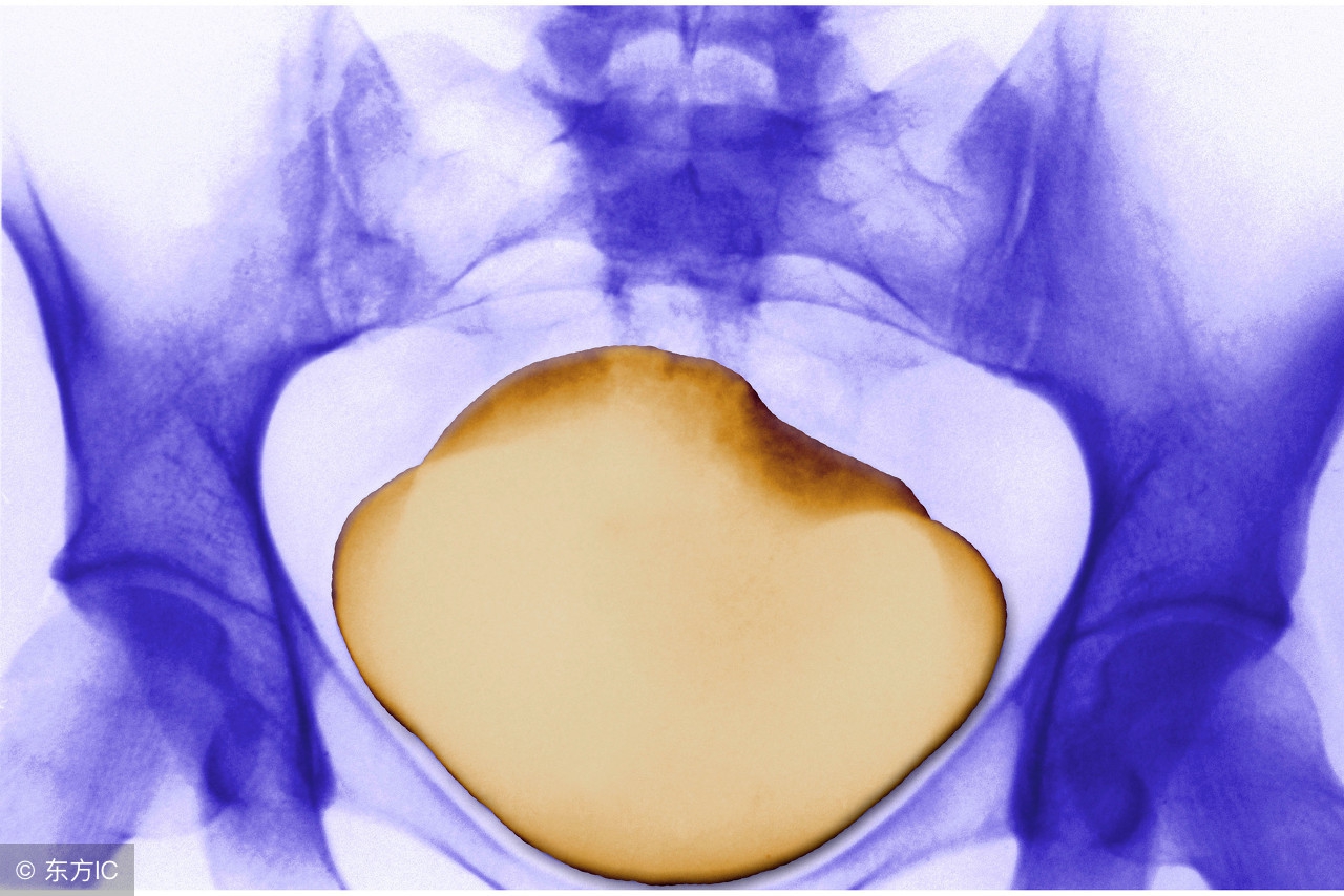 尿结石会不痛不痒尿血吗,尿结石不痛但没下来
