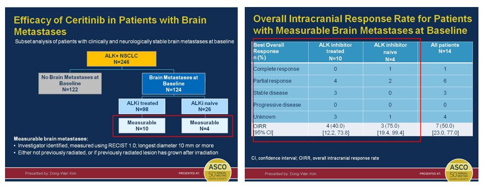 肺癌脑转移阿法替尼,alk阳性肺癌