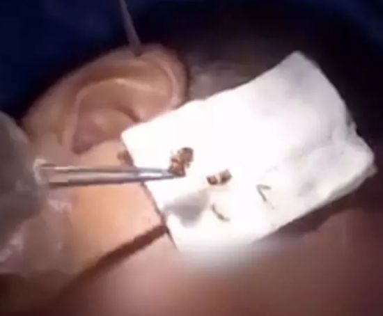 女子持续发烧,女子连续发烧三天39度