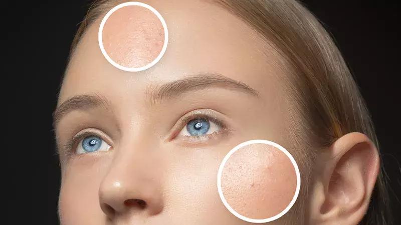 基础护肤|不同肤质的护肤重点(油皮篇)