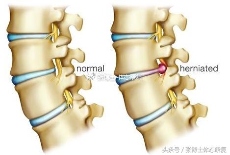 运动康复学治疗腰间盘突出,运动康复腰椎间盘突出
