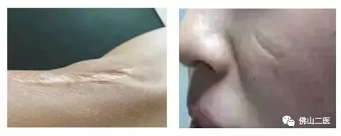 疤痕没那么可怕找对方法即可淡疤,有疤痕的你还在为疤痕烦恼吗