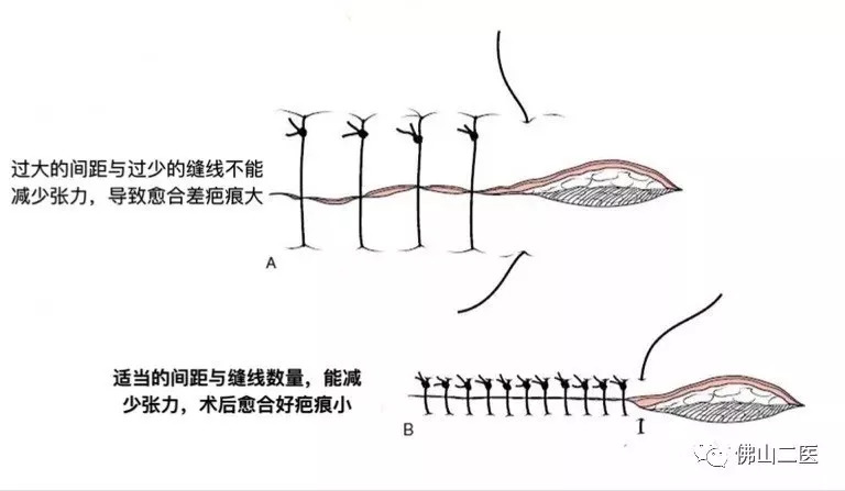 疤痕没那么可怕找对方法即可淡疤,有疤痕的你还在为疤痕烦恼吗