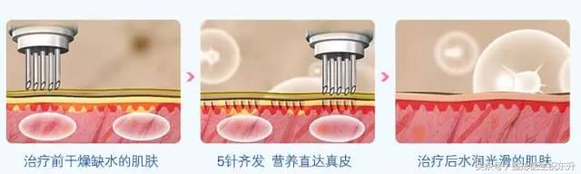 水光针打几针能改善毛孔,水光针打一次效果图