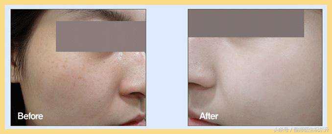 水光针打几针能改善毛孔,水光针打一次效果图