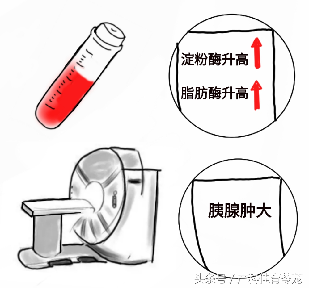 妊娠期急性胰腺炎个案护理,妊娠期急性胰腺炎症状