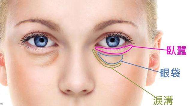 眼袋可以改善成卧蚕吗,祛除眼袋手术会把卧蚕去掉吗