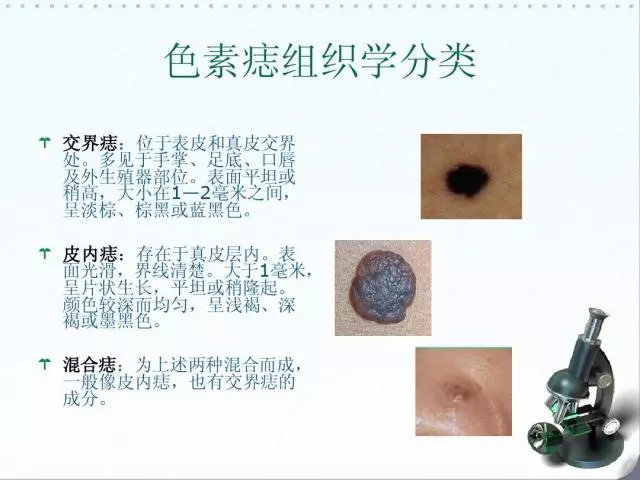 色素痣是手术去除还是激光去除好,头上长个色素痣门诊能激光去除吗