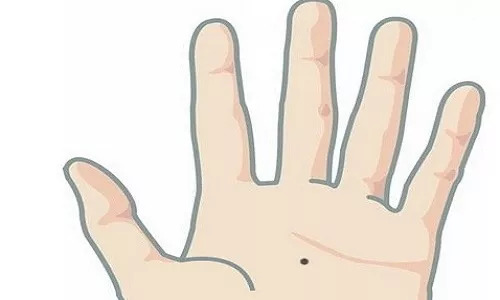 色素痣是手术去除还是激光去除好,头上长个色素痣门诊能激光去除吗