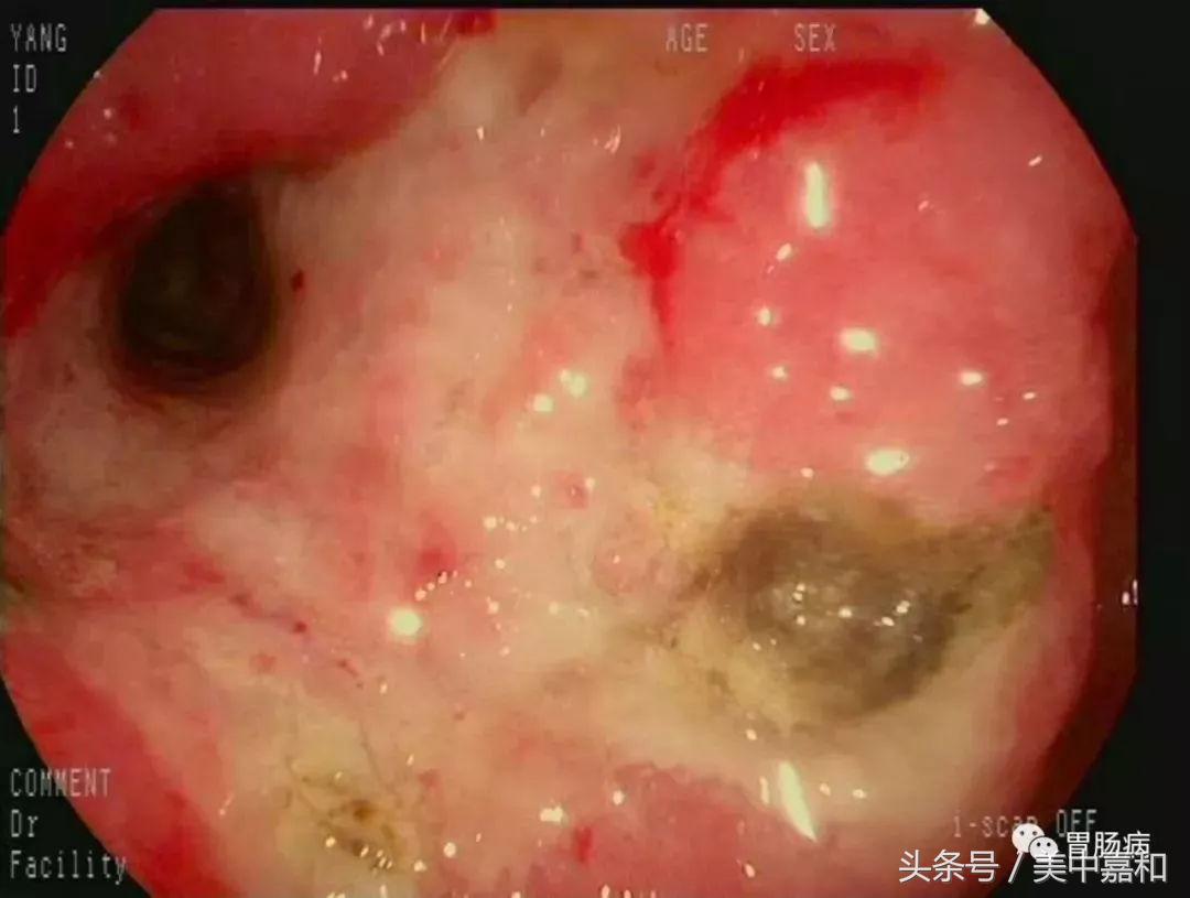 暗红色的便血一定是肠癌吗,大便便血是什么病的预兆